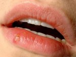 Free Prevasore cold sore cream